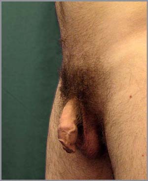 Erection stage Flaccid penis
