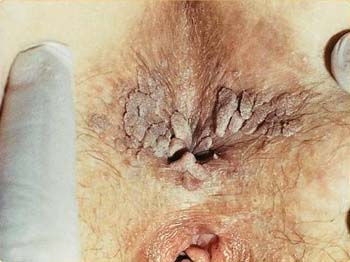 sex therapy HPV (Human Papilloma Virus) infection and wart around anus