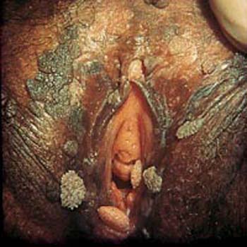 sex therapy HPV (Human Papilloma Virus) infection and  wart in female around vagina and vulva