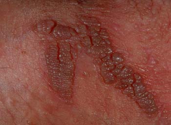 sex therapy HPV (Human Papilloma Virus) wart on groin