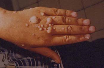 sex therapy HPV (Human Papilloma Virus)hand infection and wart and infection