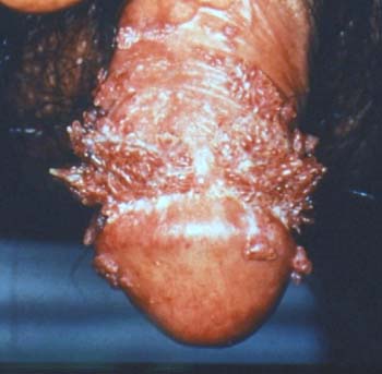 sex therapy HPV (Human Papilloma Virus) infection and  warts in a man on penis