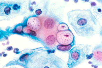 sex therapy Chlamydia as seen under microscope a pap sample