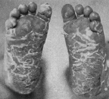 sex therapy congenital syphilis in an infant feet