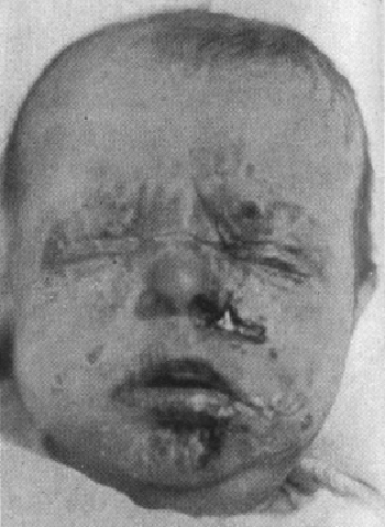 sex therapy secondary syphilis in a newborn face