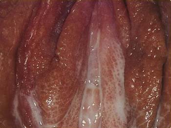sex therapy  gonorrhea in female with thick yellow discharge from vulva and vagina