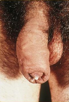 sex therapy gonorrhea in male with yellow dischrge from penis