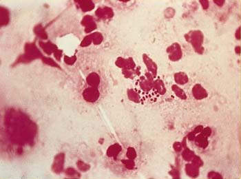 sex therapy Gonorrhea bacteria treponema pallidum under microscope