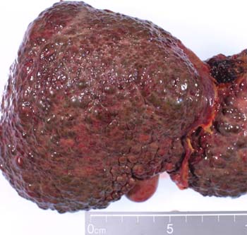 sex therapy hepatitis C cirrhosis liver with large nodules and fibrosis 