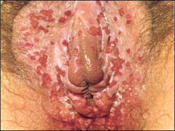 sex therapy herpes simplex female infection involving vagina and vulva
