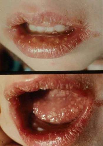 sex therapy herpes simplex face lip and mouth infection