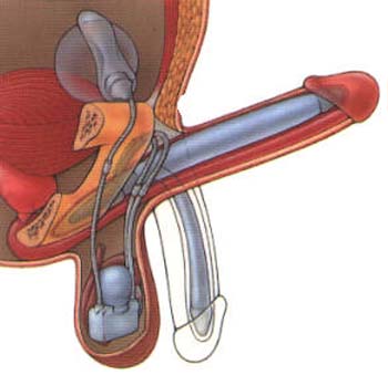 sex therapy penile prosthesis inflatable showing mechanism of action