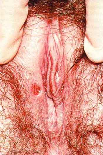 sex therapy primary syphilis in female on vulva