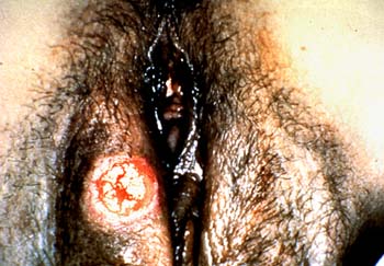 Primary syphilis in a female on vulva