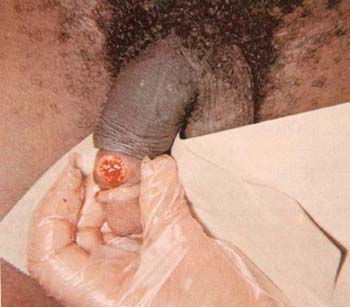 sex therapy primary syphilis in a male on penis