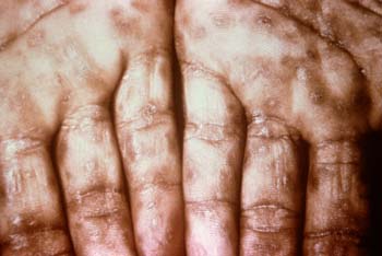 sex therapy secondary syphilis on palms