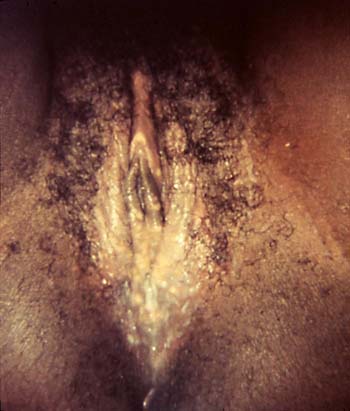 sex therapy vagina and vulva trichomoniasis, green discharge from vagina